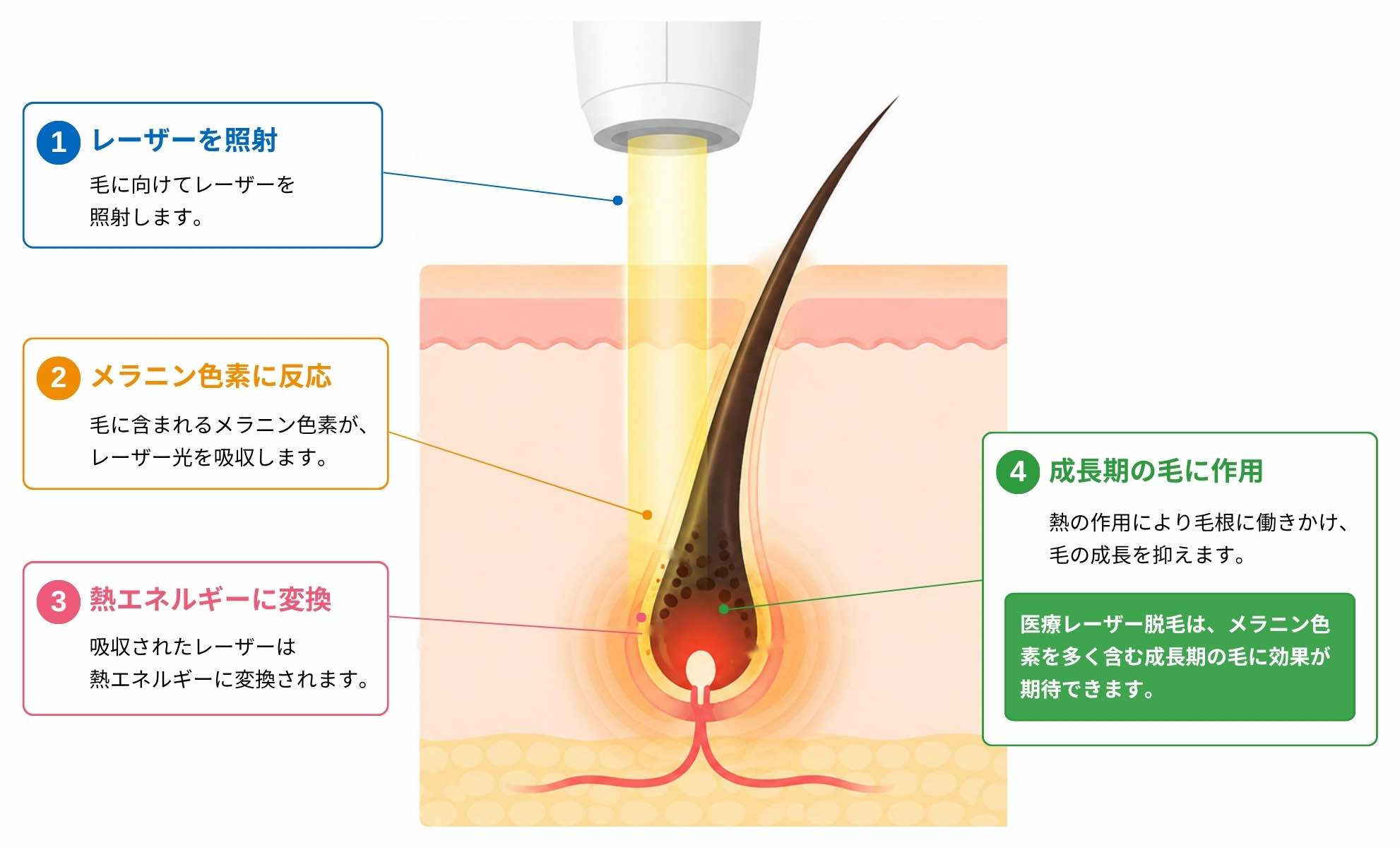 医療レーザー脱毛の仕組みを示した図