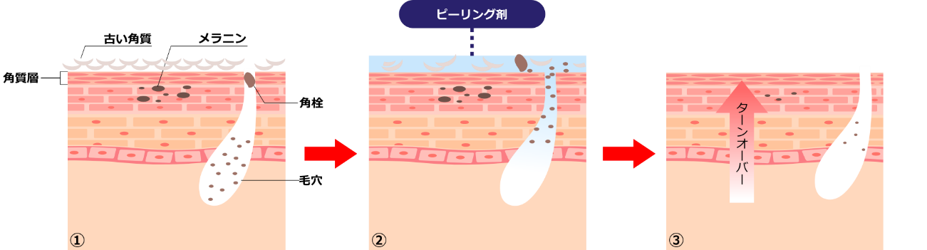 サリチル酸ピーリングのイメージ画像